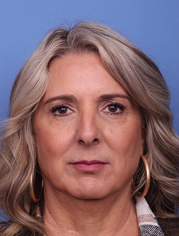 لیفت صورت در اصفهان 7 11 2