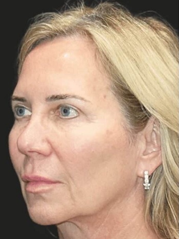 لیفت صورت در اصفهان 9 13 5