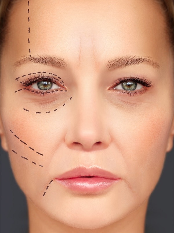 تزریق فیلر و ژل در اصفهان 2 3 1