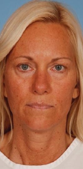 بلفاروپلاستی در اصفهان 7 3 4