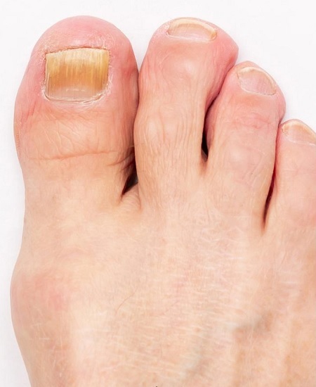 درمان قارچ ناخن 4 4 8