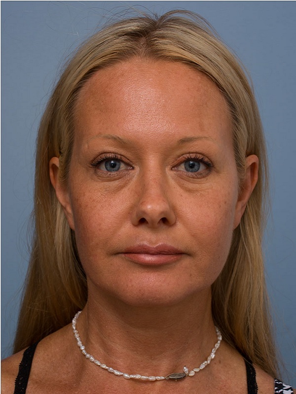 تزریق فیلر و ژل در اصفهان 6 5 2