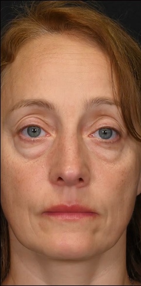 بلفاروپلاستی در اصفهان 9 5 4