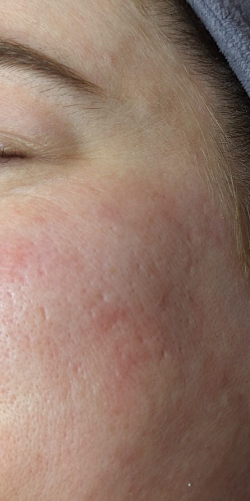 میکرونیدلینگ در اصفهان 5 6 1