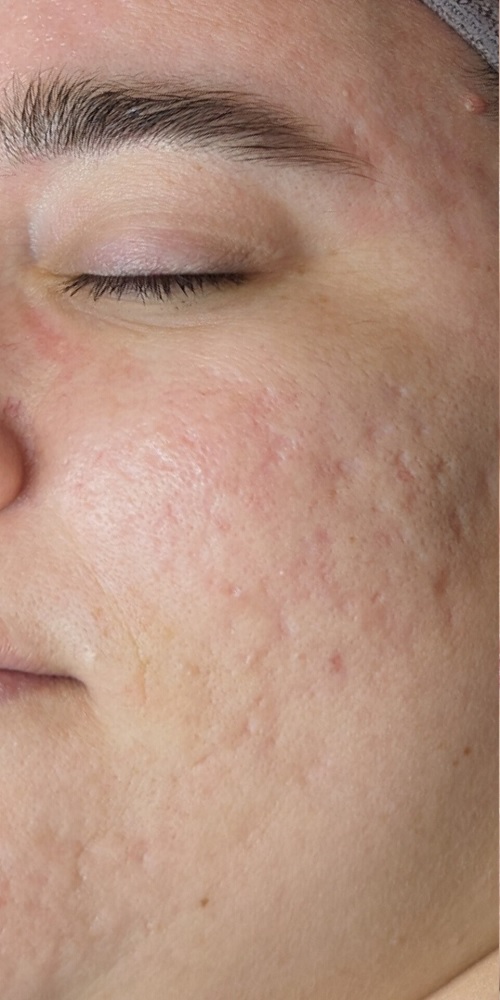 میکرونیدلینگ در اصفهان 7 8 1