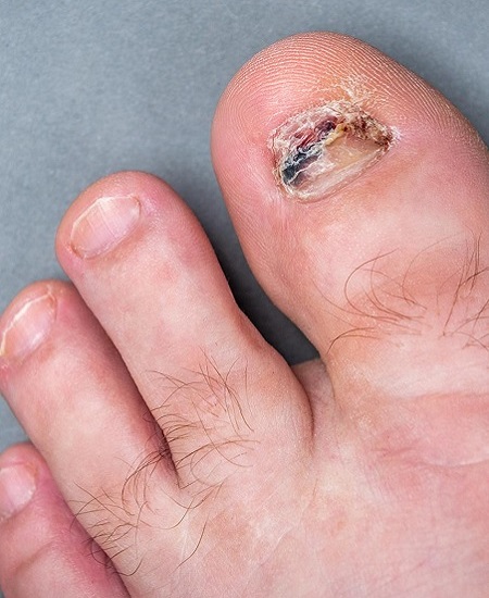 درمان قارچ ناخن 6 8 9