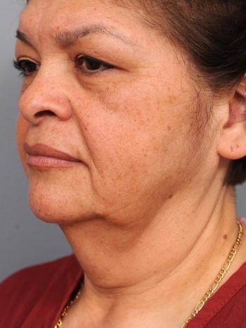 لیفت صورت در اصفهان 5 9 6