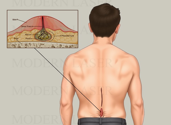 رفع تیرگی زیر چشم در اصفهان 4 استرس جراحی کیست مویی 2