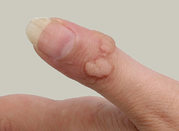 رفع تیرگی زیر چشم در اصفهان 6 زگیل