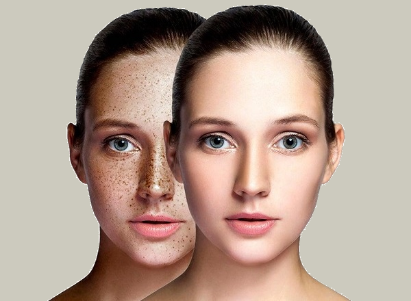 رفع تیرگی زیر چشم در اصفهان 7 مم