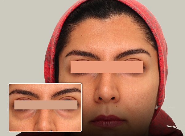 درمان کیست مویی با لیزر 7 پف زیر چشم