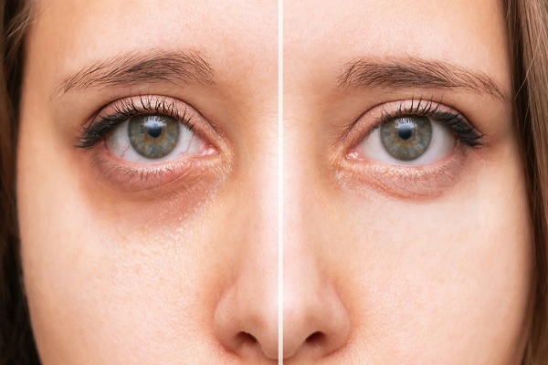 اندولیفت زیر چشم؛ درمان پف و تیرگی زیر چشم بدون جراحی 3 مراحل انجام اندولیفت زیر چشم