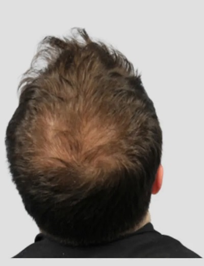 مزوتراپی مو در اصفهان 5 o1 2