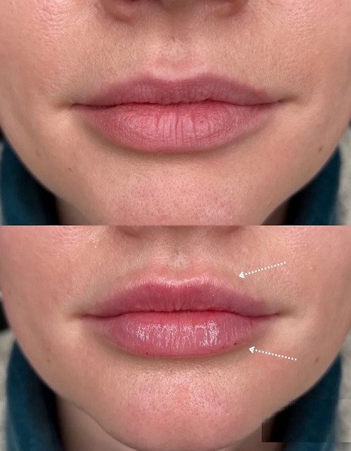 تزریق فیلر و ژل در اصفهان 11 o2