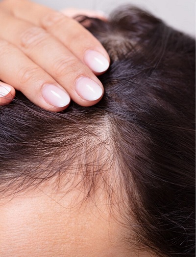 مزوتراپی مو در اصفهان 7 p1