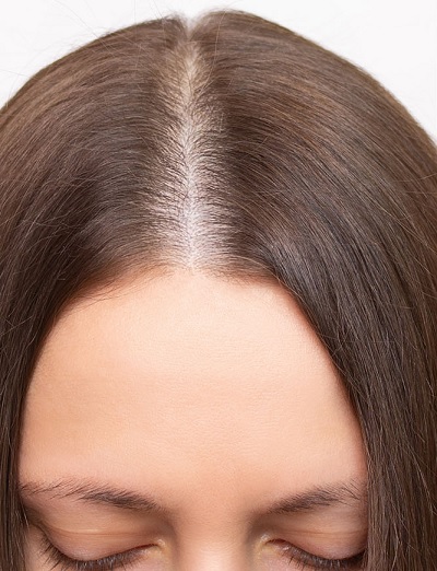 مزوتراپی مو در اصفهان 3 y1