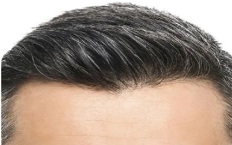 خط رویش طبیعی در کاشت مو؛ راز زیبایی و طبیعی بودن نتیجه 1 اهمیت خط رویش طبیعی در کاشت مو