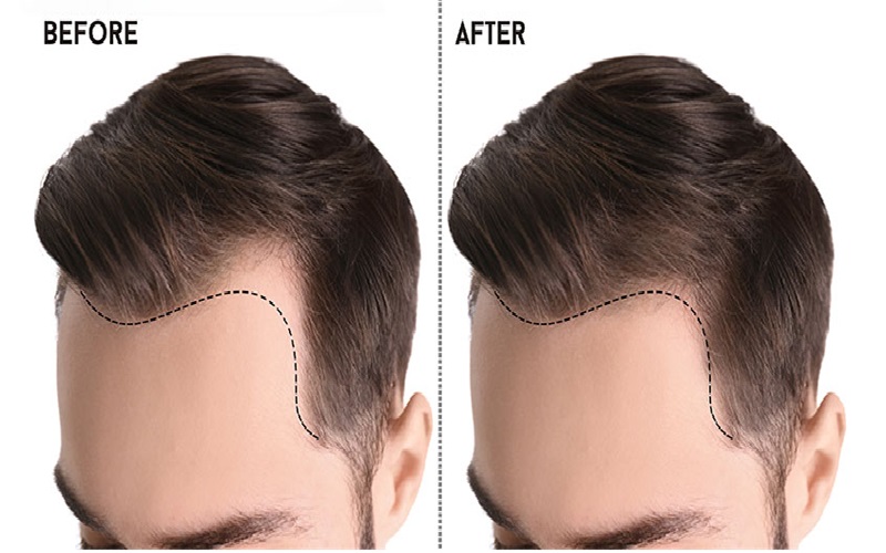 بهترین سن برای کاشت مو 1 چرا سن در کاشت مو اهمیت دارد؟