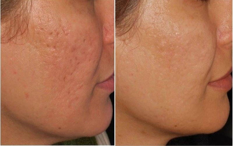 سابسیژن با اندولیفت چیست و چه کاربردی دارد؟ 1 سابسیژن با اندولیفت چیست؟