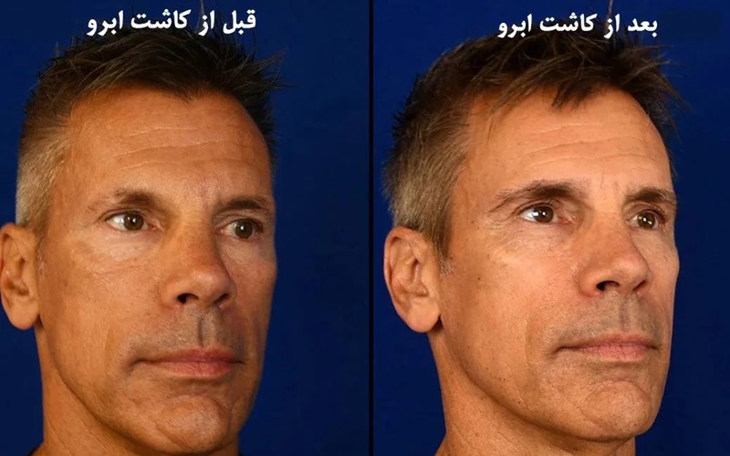 کاشت ابروی آقایان: بهترین روش برای داشتن ابروهای مردانه 1 چرا کاشت ابروی آقایان اهمیت دارد؟