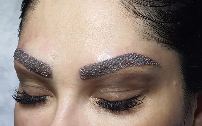 کاشت ابرو با بانک موی دیگران قابل انجام است؟ بررسی کامل روش، مزایا و معایب 2 معایب و چالشهای کاشت ابرو با بانک موی دیگران