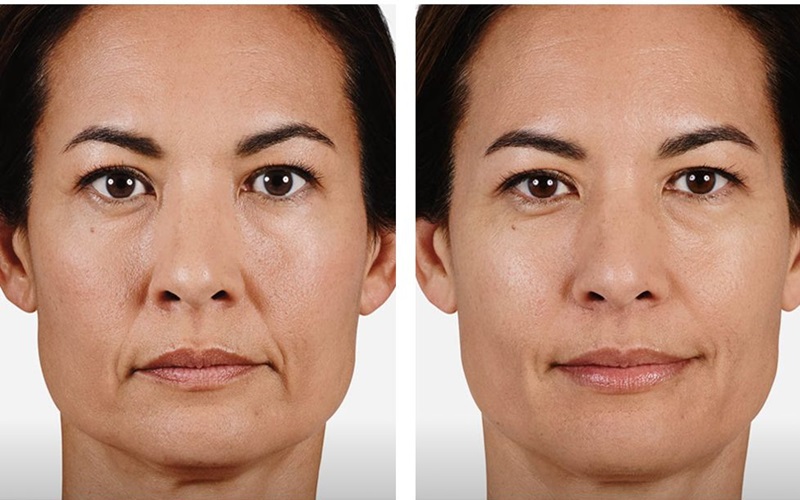 آیا تزریق کلاژن برای جوانسازی پوست مؤثر است؟ 1 تزریق کلاژن چیست و چگونه عمل میکند