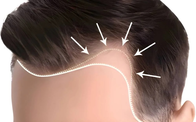 خط رویش طبیعی در کاشت مو؛ راز زیبایی و طبیعی بودن نتیجه 3 اشتباهات رایج در طراحی خط رویش مو