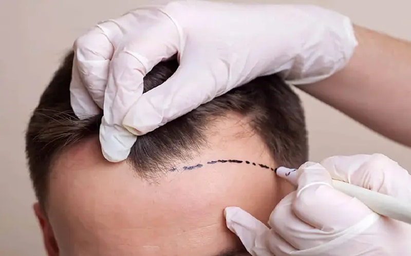 مراقبت از موی کاشته شده؛ چگونه از موهای کاشته شده خود مراقبت کنیم؟ 3 نکات پیشرفته مراقبت از موی کاشته شده