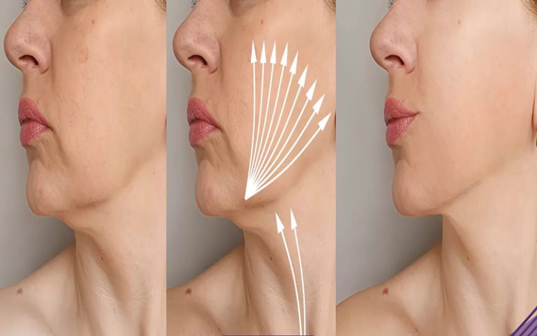 جوانسازی با نخ