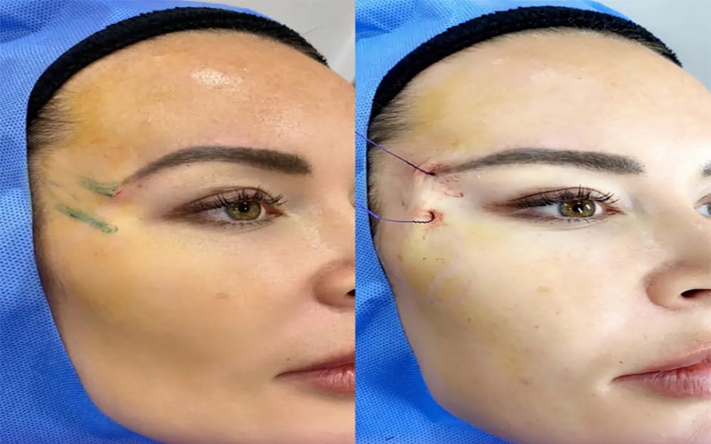 جوانسازی با نخ چگونه انجام میشود؟ 1 ب 1