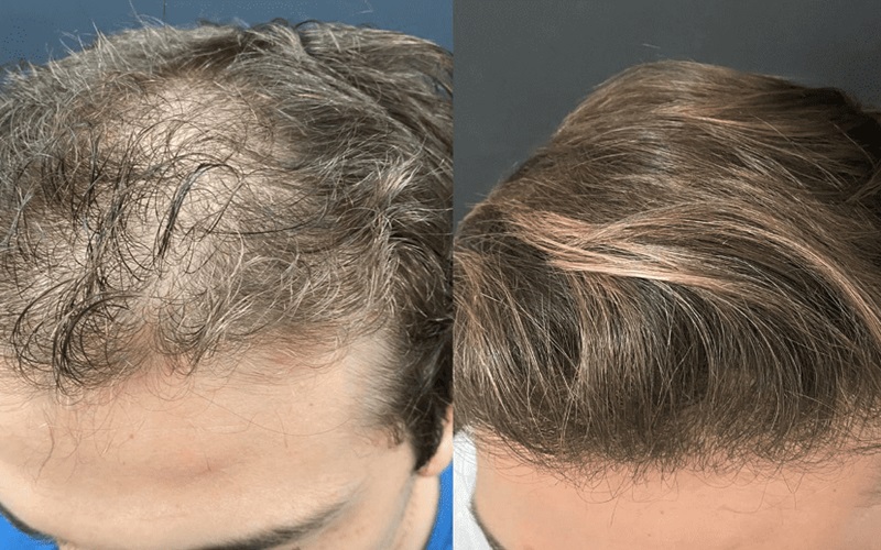 آیا کاشت مو با استفاده از بانک موی افراد دیگر امکان پذیر است؟ 3 جایگزینهای ایمن برای کسانی که بانک موی کافی ندارند