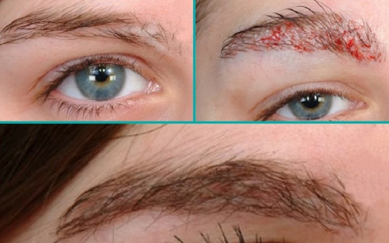 پیوند ابرو چیست؟ + معرفی روشها 3 مزایای پیوند ابرو