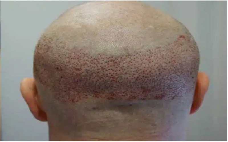 آیا ورم بعد از کاشت مو طبیعی است؟ 2 چرا ورم بعد از کاشت مو اتفاق میافتد؟