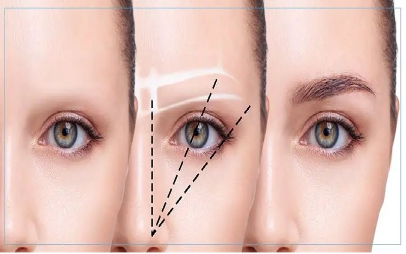 کاشت ابرو طبیعی | کدام روش کاشت ابرو، بهتر است؟ 1 کاشت ابرو به روش FUE (استخراج واحد فولیکولی)