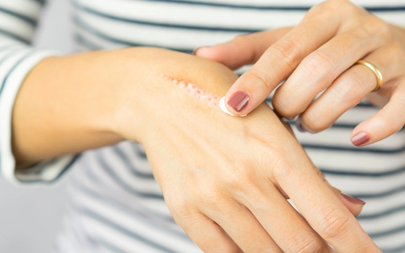 راهکارهایی برای زودتر خوب شدن زخم 2 تمیز نگه داشتن زخم؛ پایه اصلی خوب شدن زخم