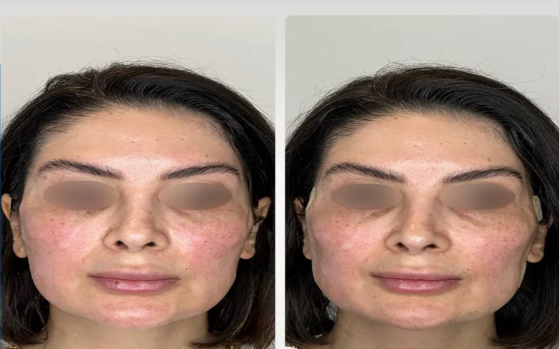 جوانسازی با نخ چگونه انجام میشود؟ 3 جوانسازی با نخ در ترکیب با روشهای دیگر