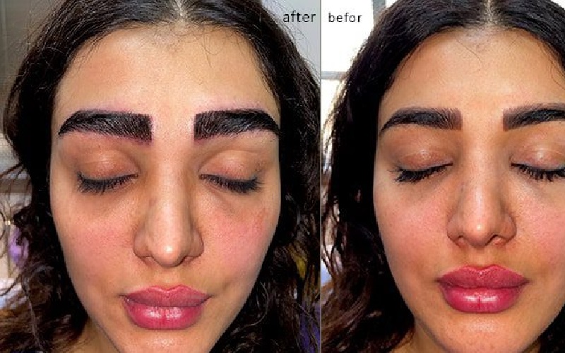 کاشت ابرو به روش FUE و مقایسه با دیگر روشها 1 کاشت ابرو به روش FUE چیست؟