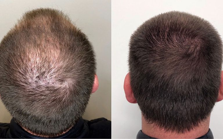 کاشت مو و میکرواسکالپ