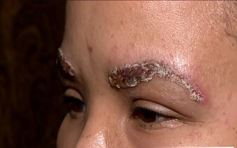 دلمه های پس از کاشت ابرو و مراقبتهای آن | راهنمای کامل 3 نکات تکمیلی برای پیشگیری از مشکلات دلمهها