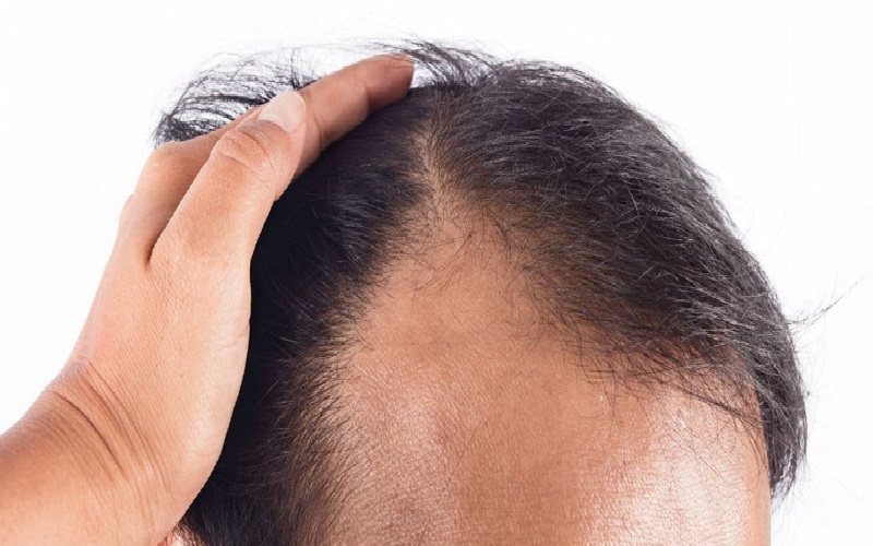 تاثیر ژن بر ریزش مو: همه آنچه باید بدانید 3 علل تشدیدکننده ریزش موی ژنتیکی