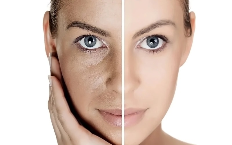 اندولیفت بهتر است یا هایفو؟ | مقایسه هایفوتراپی و اندولیفت 3 مقایسه هایفوتراپی و اندولیفت از نظر هزینه