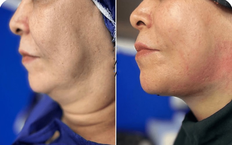 جراحی رفع غبغب چیست و چگونه انجام میشود؟ 1 لیپوساکشن غبغب