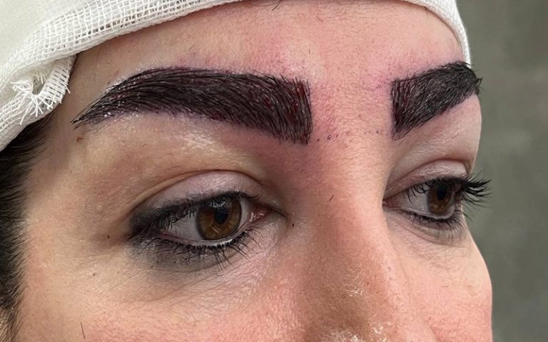 کاشت ابرو به روش میکروگرافت