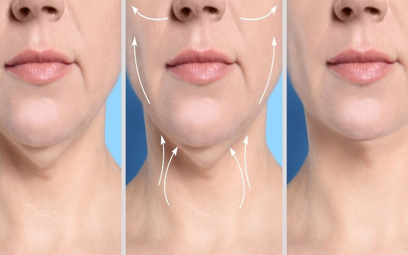 مزایای از بین بردن غبغب با هایفوتراپی 1 از بین بردن غبغب با هایفوتراپی چیست؟