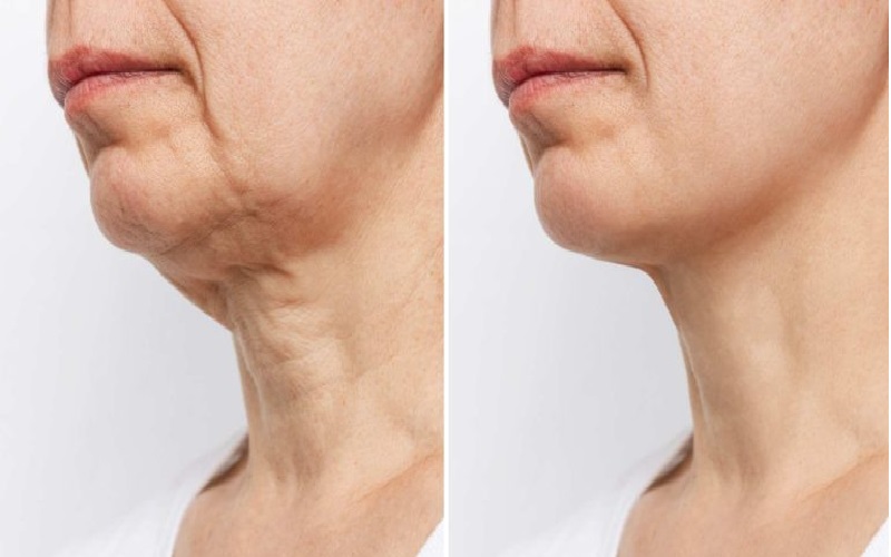 جراحی رفع غبغب چیست و چگونه انجام میشود؟ 2 تت 4