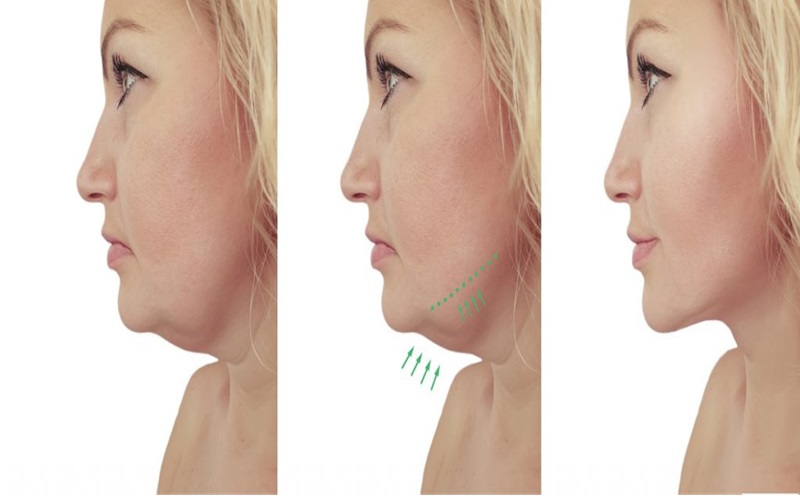 جراحی رفع غبغب چیست و چگونه انجام میشود؟ 3 ترکیبی از لیپوساکشن و کشیدن پوست