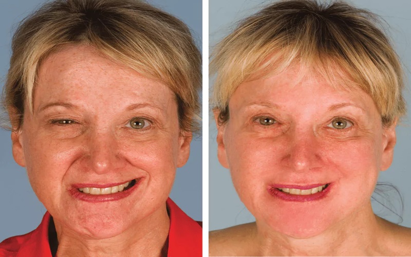 از بین بردن اثر بوتاکس در خانه: راهکارها و نکات مهم 2 کاهش مصرف مکمل روی (Zinc)