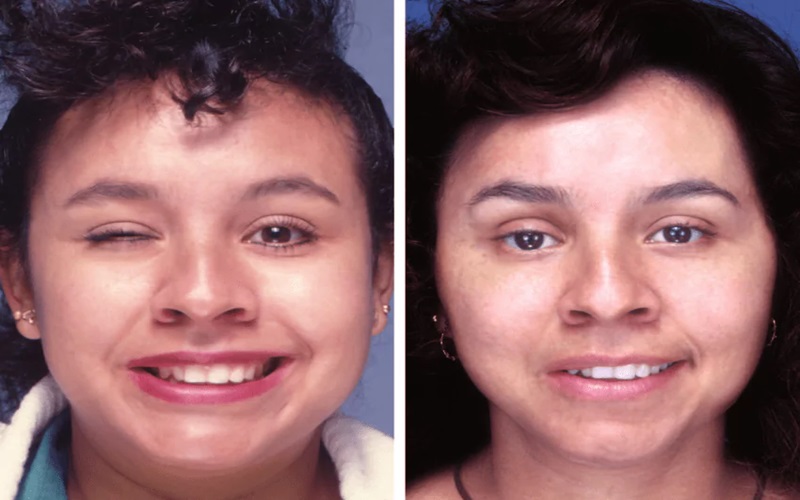 از بین بردن اثر بوتاکس در خانه: راهکارها و نکات مهم 3 روشهای تکمیلی برای کمک به از بین بردن اثر بوتاکس در خانه