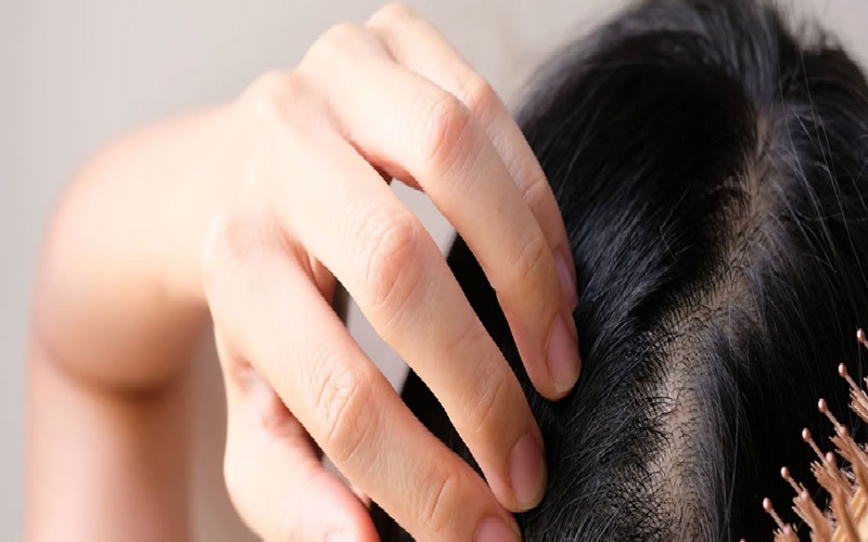 تاثیر رژیم لاغری بر ریزش مو: راهنمای کامل جلوگیری از ریزش مو هنگام کاهش وزن 1 چرا رژیم لاغری میتواند باعث ریزش مو شود؟