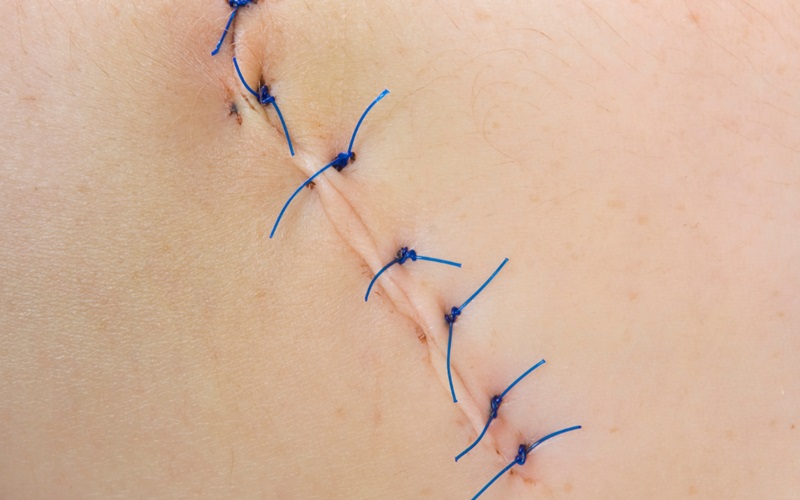 روش کشیدن بخیه در منزل 1 اهمیت کشیدن به موقع بخیه و تأثیر آن بر روند بهبود زخم